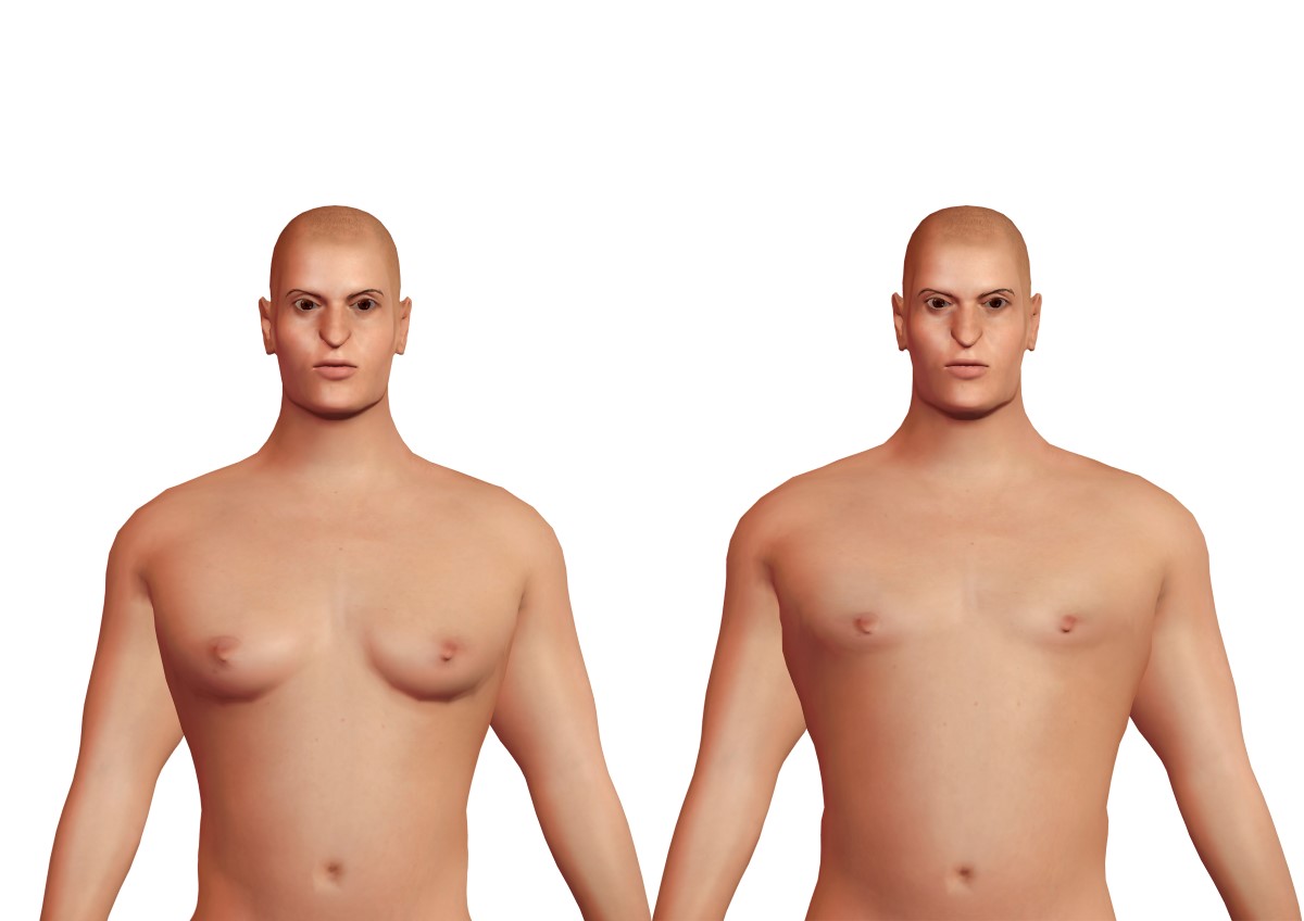 Gynekomastia a fyziologické prsia u muža